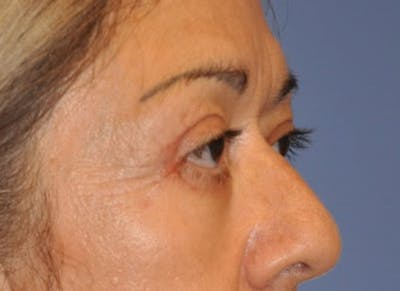 Blepharoplasty (Eyelid Surgery) Before & After Gallery - Patient 13574741 - Image 4