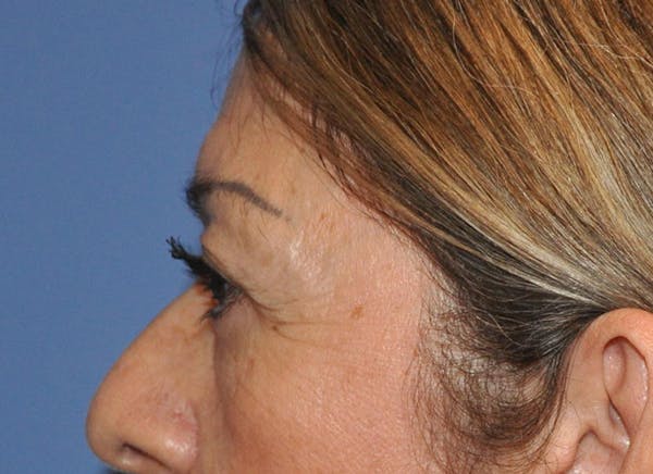 Blepharoplasty (Eyelid Surgery) Before & After Gallery - Patient 13574741 - Image 5