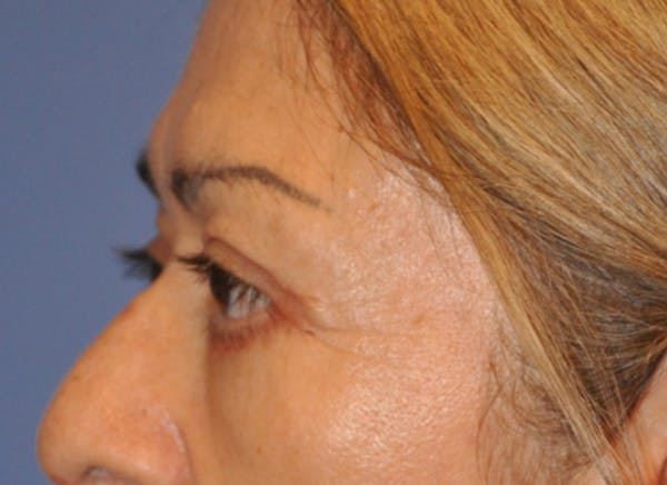 Blepharoplasty (Eyelid Surgery) Before & After Gallery - Patient 13574741 - Image 6