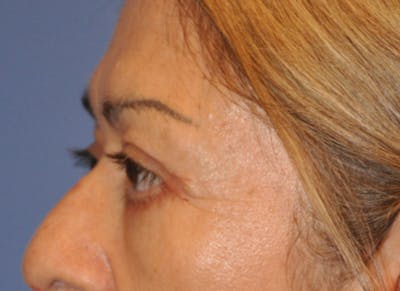 Blepharoplasty (Eyelid Surgery) Before & After Gallery - Patient 13574741 - Image 6