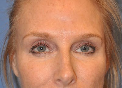 Blepharoplasty (Eyelid Surgery) Before & After Gallery - Patient 13574742 - Image 1