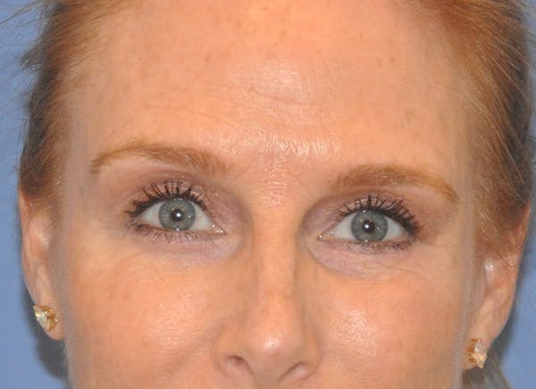 Blepharoplasty (Eyelid Surgery) Before & After Gallery - Patient 13574742 - Image 2