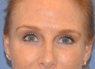 Blepharoplasty (Eyelid Surgery) Before & After Gallery - Patient 13574742 - Image 2
