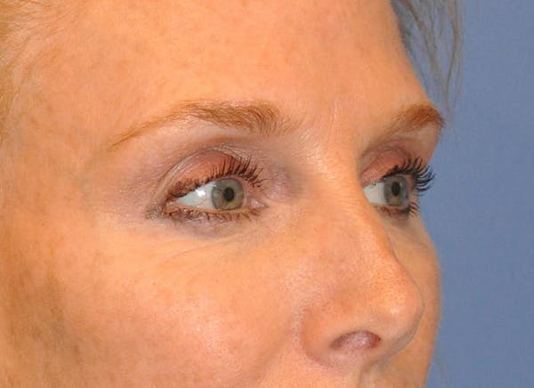 Blepharoplasty (Eyelid Surgery) Before & After Gallery - Patient 13574742 - Image 3
