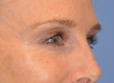 Blepharoplasty (Eyelid Surgery) Gallery - Patient 13574742 - Image 4
