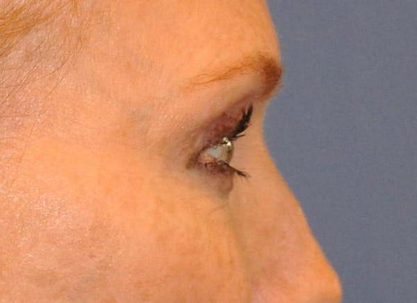 Blepharoplasty (Eyelid Surgery) Before & After Gallery - Patient 13574742 - Image 5