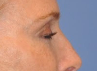 Blepharoplasty (Eyelid Surgery) Before & After Gallery - Patient 13574742 - Image 6