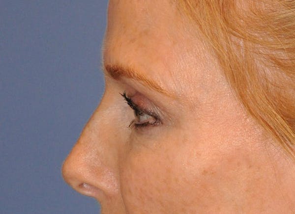Blepharoplasty (Eyelid Surgery) Before & After Gallery - Patient 13574742 - Image 7