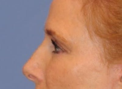 Blepharoplasty (Eyelid Surgery) Before & After Gallery - Patient 13574742 - Image 8