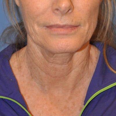Neck Lift Before & After Gallery - Patient 13574745 - Image 1