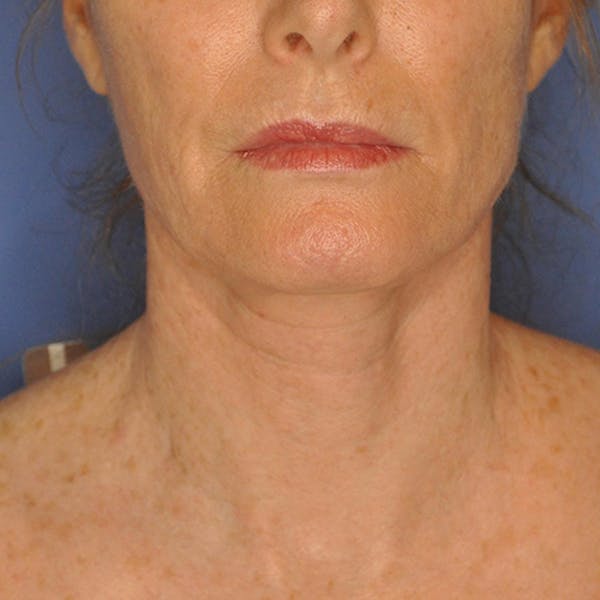 Neck Lift Before & After Gallery - Patient 13574745 - Image 2