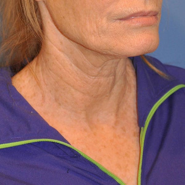 Neck Lift Before & After Gallery - Patient 13574745 - Image 3