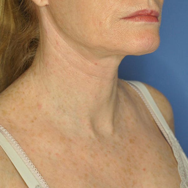 Neck Lift Before & After Gallery - Patient 13574745 - Image 4