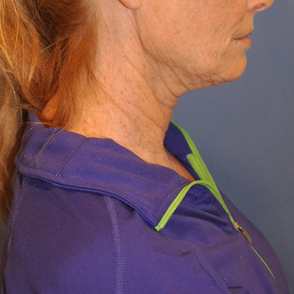 Neck Lift Before & After Gallery - Patient 13574745 - Image 5