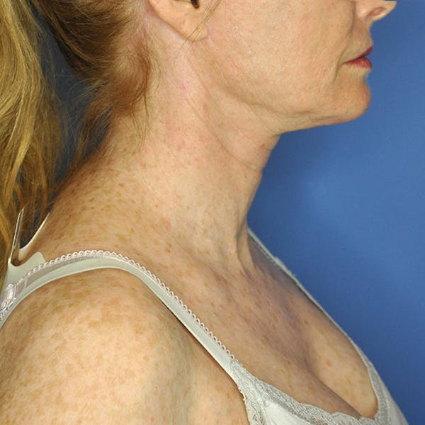 Neck Lift Before & After Gallery - Patient 13574745 - Image 6