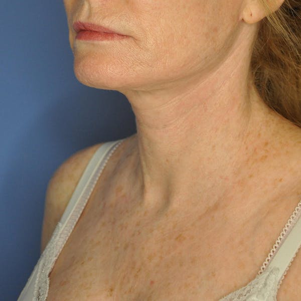 Neck Lift Before & After Gallery - Patient 13574745 - Image 8