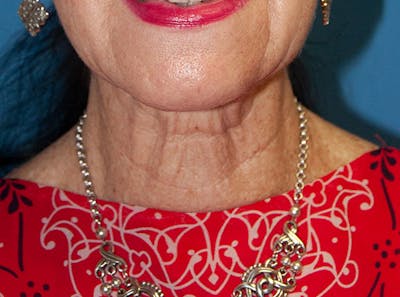 Neck Lift Before & After Gallery - Patient 13574746 - Image 1