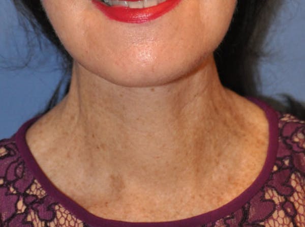 Neck Lift Before & After Gallery - Patient 13574746 - Image 2