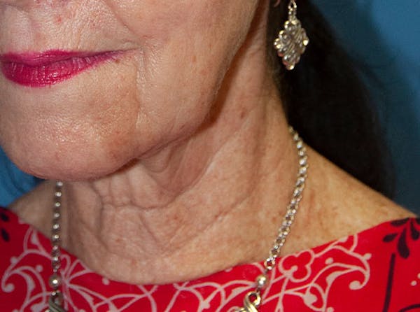 Neck Lift Before & After Gallery - Patient 13574746 - Image 3