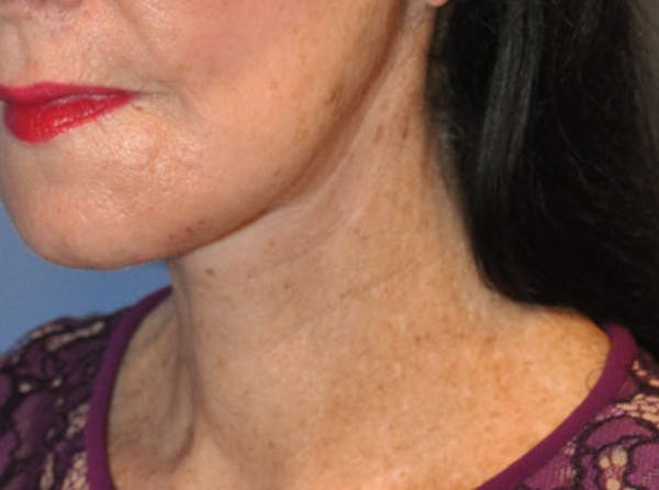 Neck Lift Before & After Gallery - Patient 13574746 - Image 4