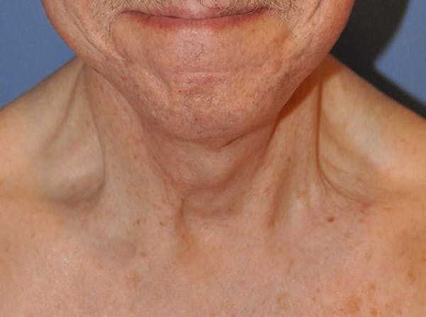 Neck Lift Before & After Gallery - Patient 13574747 - Image 2