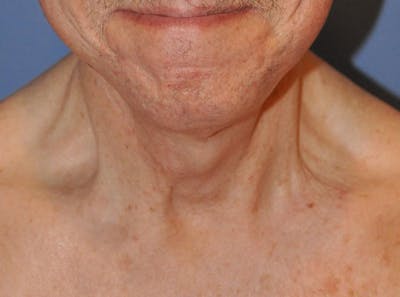 Neck Lift Before & After Gallery - Patient 13574747 - Image 2