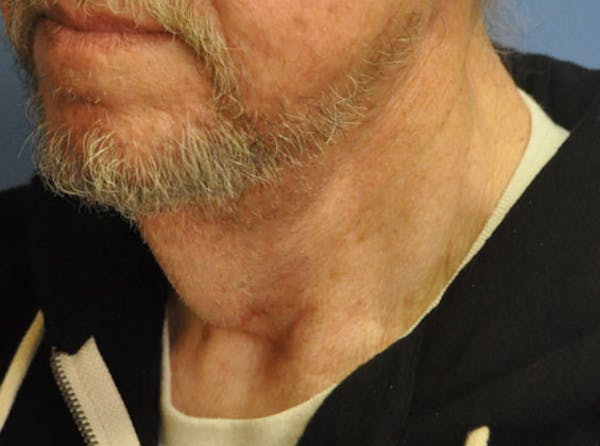 Neck Lift Before & After Gallery - Patient 13574747 - Image 3