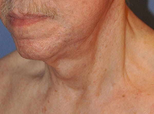 Neck Lift Before & After Gallery - Patient 13574747 - Image 4