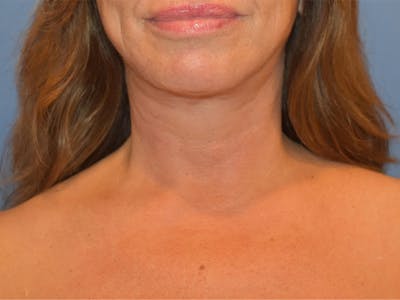 Neck Lift Before & After Gallery - Patient 13574757 - Image 2