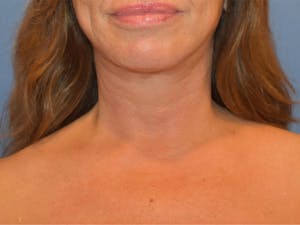 Before and After Neck Lift in Newport Beach