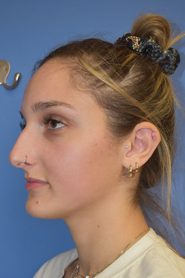 Liquid Rhinoplasty Before & After Gallery - Patient 13574760 - Image 3