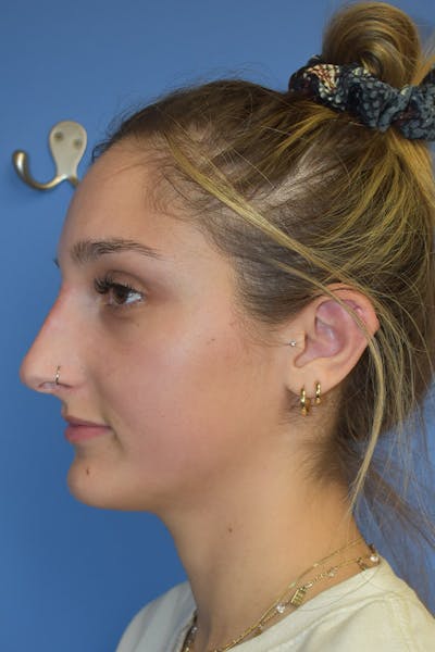 Liquid Rhinoplasty Before & After Gallery - Patient 13574760 - Image 4
