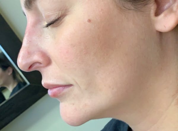 Liquid Rhinoplasty Before & After Gallery - Patient 13574761 - Image 1
