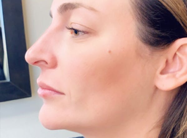 Liquid Rhinoplasty Before & After Gallery - Patient 13574761 - Image 2
