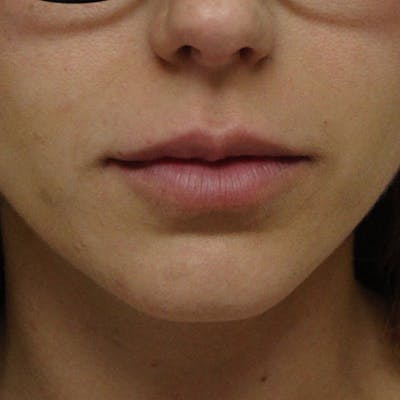 Lip Augmentation Before & After Gallery - Patient 13574765 - Image 1