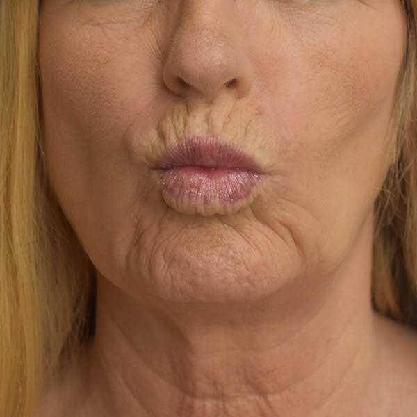 Lip Augmentation Before & After Gallery - Patient 13574766 - Image 1