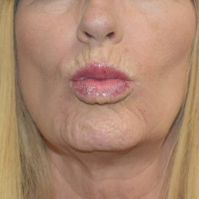 Lip Augmentation Before & After Gallery - Patient 13574766 - Image 2