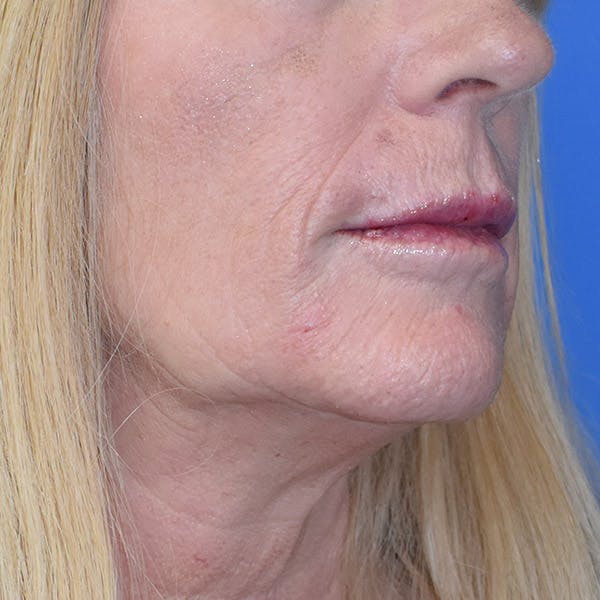 Lip Augmentation Before & After Gallery - Patient 13574766 - Image 4