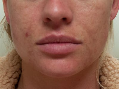 Lip Augmentation Before & After Gallery - Patient 13574767 - Image 1