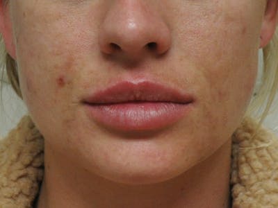 Lip Augmentation Before & After Gallery - Patient 13574767 - Image 2