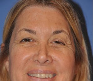 Brow Lift