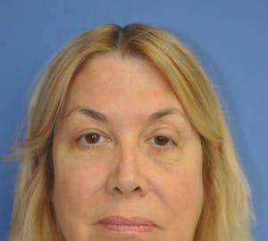 Brow Lift