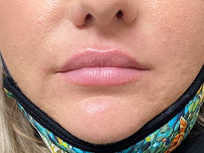 Lip Augmentation Before & After Gallery - Patient 20644492 - Image 1