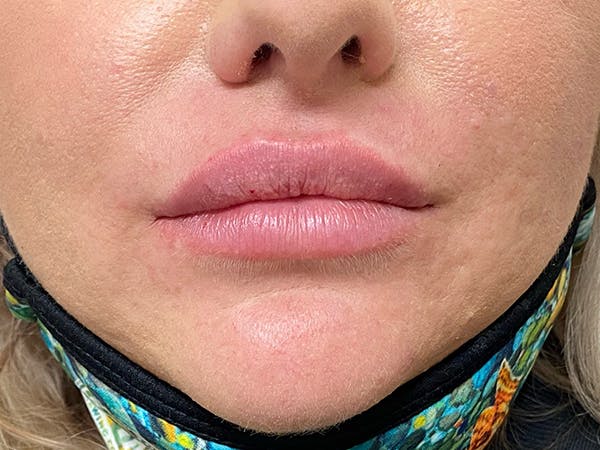 Lip Augmentation Before & After Gallery - Patient 20644492 - Image 2