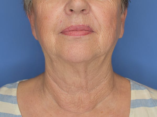 Neck Lift Before & After Gallery - Patient 21023830 - Image 1