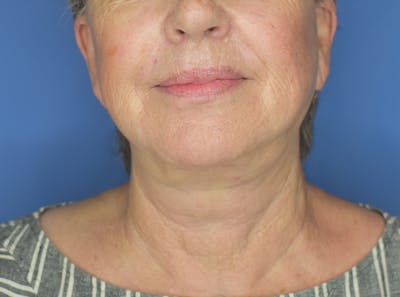 Neck Lift Before & After Gallery - Patient 21023830 - Image 2