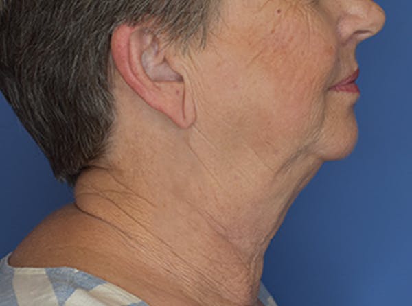 Neck Lift Before & After Gallery - Patient 21023830 - Image 3