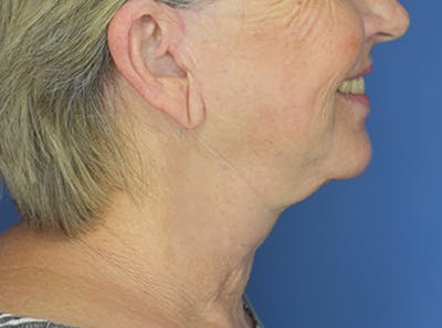 Neck Lift Before & After Gallery - Patient 21023830 - Image 4