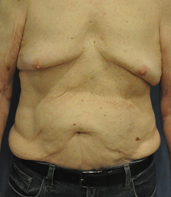 Tummy Tuck (Abdominoplasty) Before & After Gallery - Patient 21023847 - Image 1