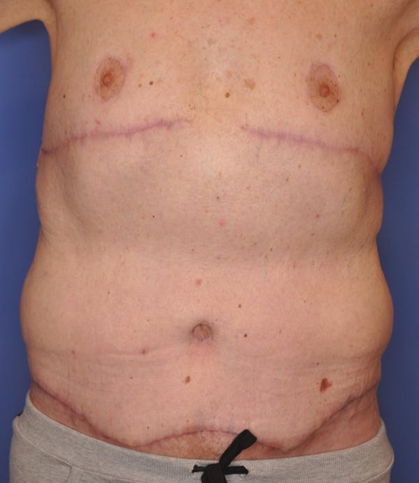 Tummy Tuck (Abdominoplasty) Before & After Gallery - Patient 21023847 - Image 2